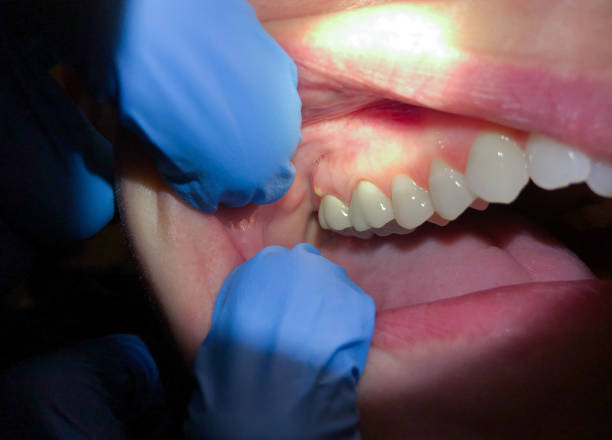 Best Emergency Tooth Extraction in Paramount, CA